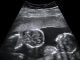 Twins and Breech Babies: Human Birth, Part 4